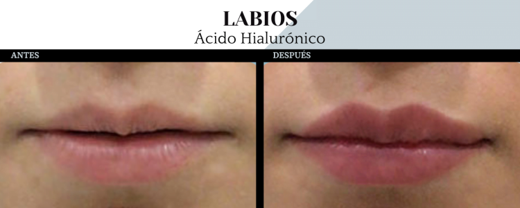 labios con ácido hialrónico